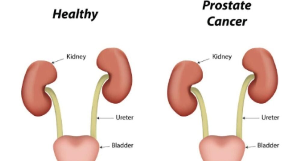 Prostate cancer