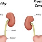 Prostate cancer